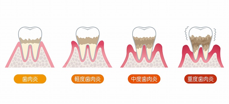 歯周病の状態